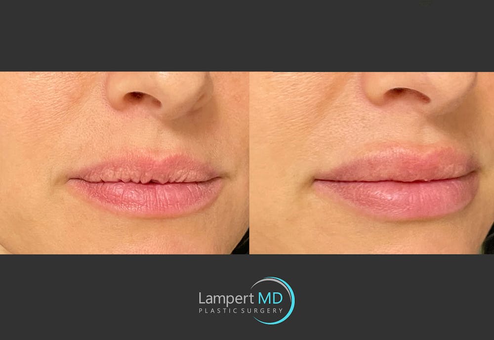 Lip Augmentation Before & After Gallery - Patient 122909263 - Image 3