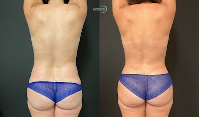 Love Handle Liposuction Before & After Gallery - Patient 170939 - Image 1