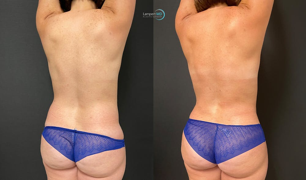Love Handle Liposuction Before & After Gallery - Patient 170939 - Image 2