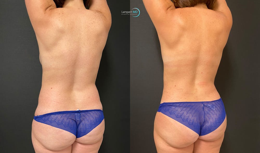 Love Handle Liposuction Before & After Gallery - Patient 170939 - Image 3