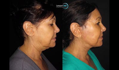 Face & Neck Lift Before & After Gallery - Patient 122908999 - Image 1