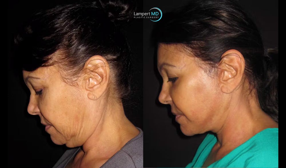 Face & Neck Lift Before & After Gallery - Patient 122908999 - Image 2