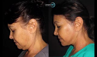 Face & Neck Lift Before & After Gallery - Patient 122908999 - Image 2