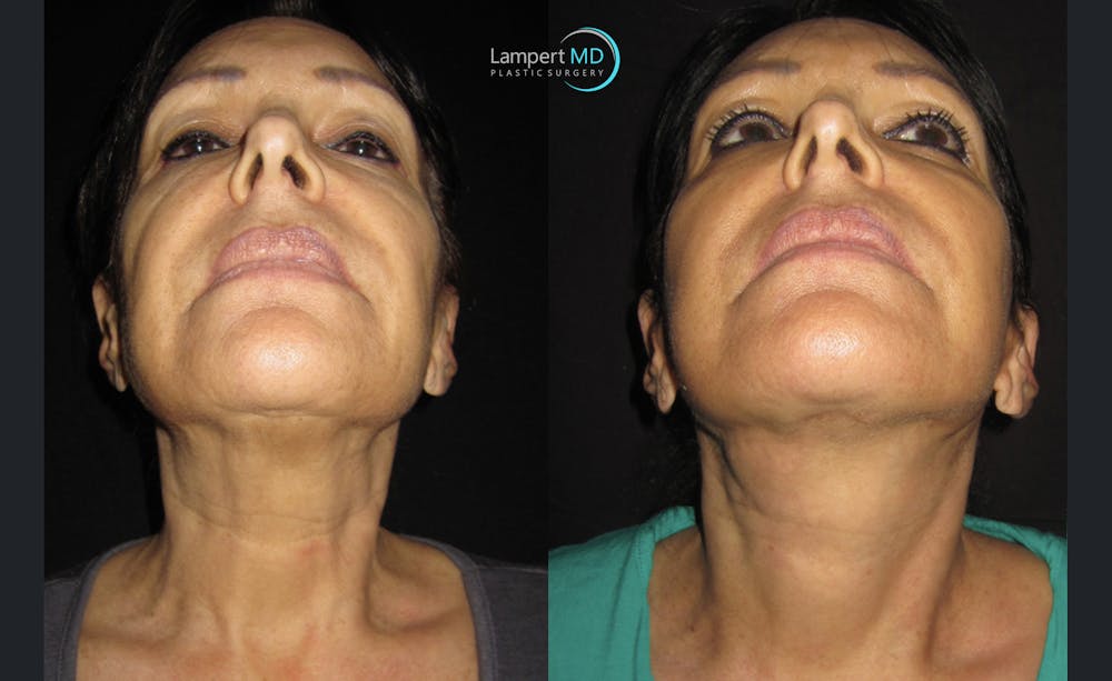 Face & Neck Lift Before & After Gallery - Patient 122908999 - Image 3