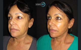 Face & Neck Lift Before & After Gallery - Patient 122908999 - Image 4