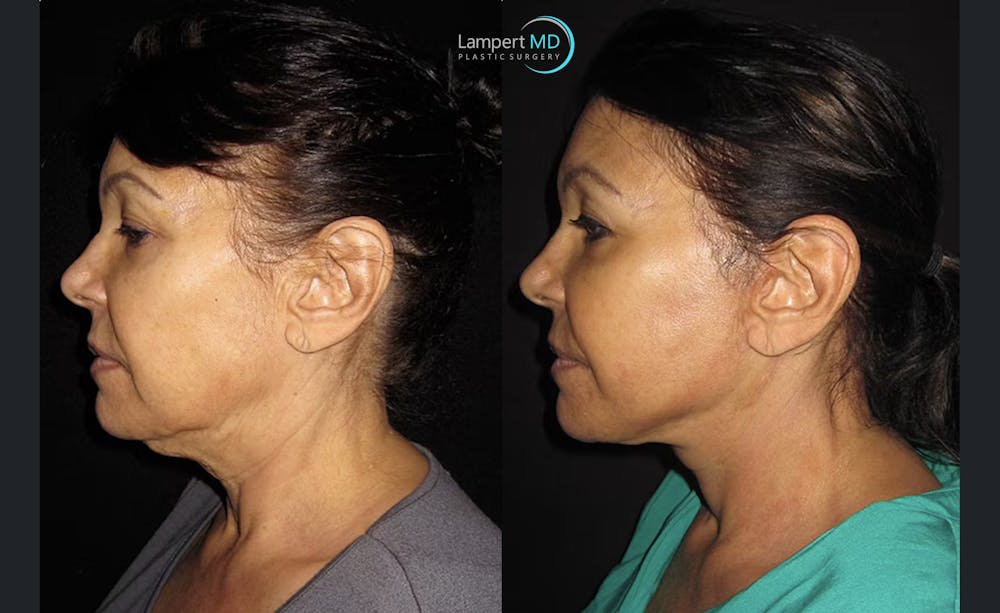 Face & Neck Lift Before & After Gallery - Patient 122908999 - Image 5