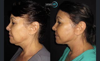 Face & Neck Lift Before & After Gallery - Patient 122908999 - Image 5
