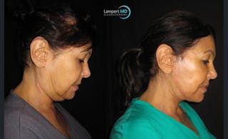 Face & Neck Lift Before & After Gallery - Patient 122908999 - Image 6