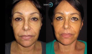 Face & Neck Lift Before & After Gallery - Patient 122908999 - Image 7