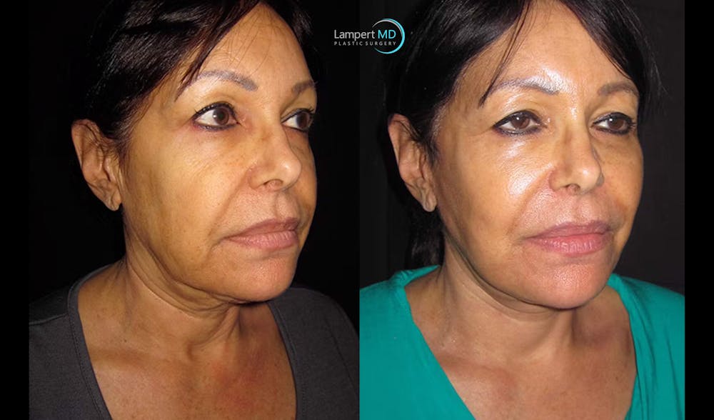 Face & Neck Lift Before & After Gallery - Patient 122908999 - Image 8