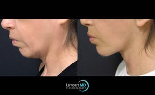 Face & Neck Lift Before & After Gallery - Patient 122909003 - Image 1