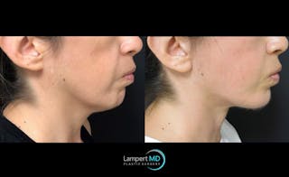 Face & Neck Lift Before & After Gallery - Patient 122909003 - Image 2