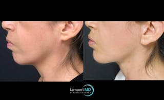 Face & Neck Lift Before & After Gallery - Patient 122909003 - Image 3