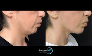 Face & Neck Lift Before & After Gallery - Patient 122909003 - Image 4