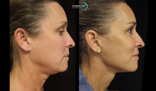 Face & Neck Lift Before & After Gallery - Patient 122908982 - Image 1