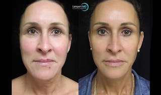 Face & Neck Lift Before & After Gallery - Patient 122908982 - Image 2