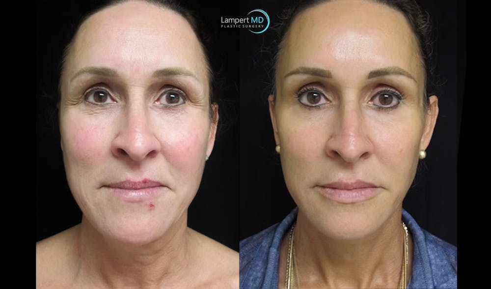 Face & Neck Lift Before & After Gallery - Patient 122908982 - Image 2