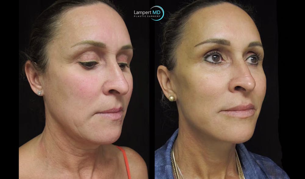 Face & Neck Lift Before & After Gallery - Patient 122908982 - Image 3