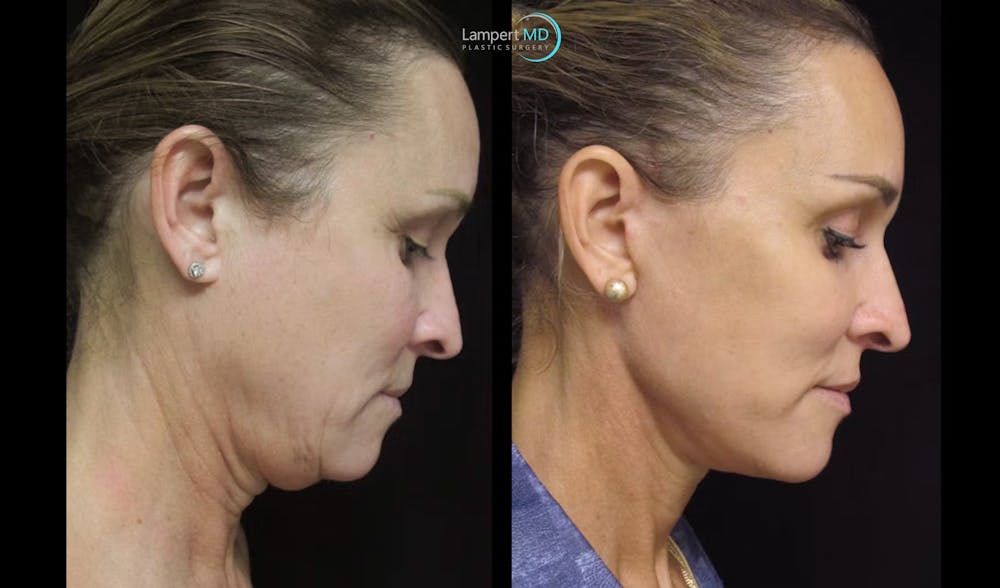 Face & Neck Lift Before & After Gallery - Patient 122908982 - Image 4