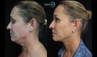 Face & Neck Lift Before & After Gallery - Patient 122908982 - Image 5