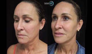 Face & Neck Lift Before & After Gallery - Patient 122908982 - Image 6