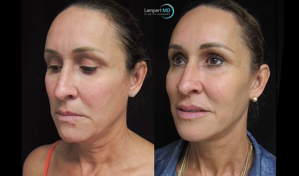Face & Neck Lift Before & After Gallery - Patient 122908982 - Image 6