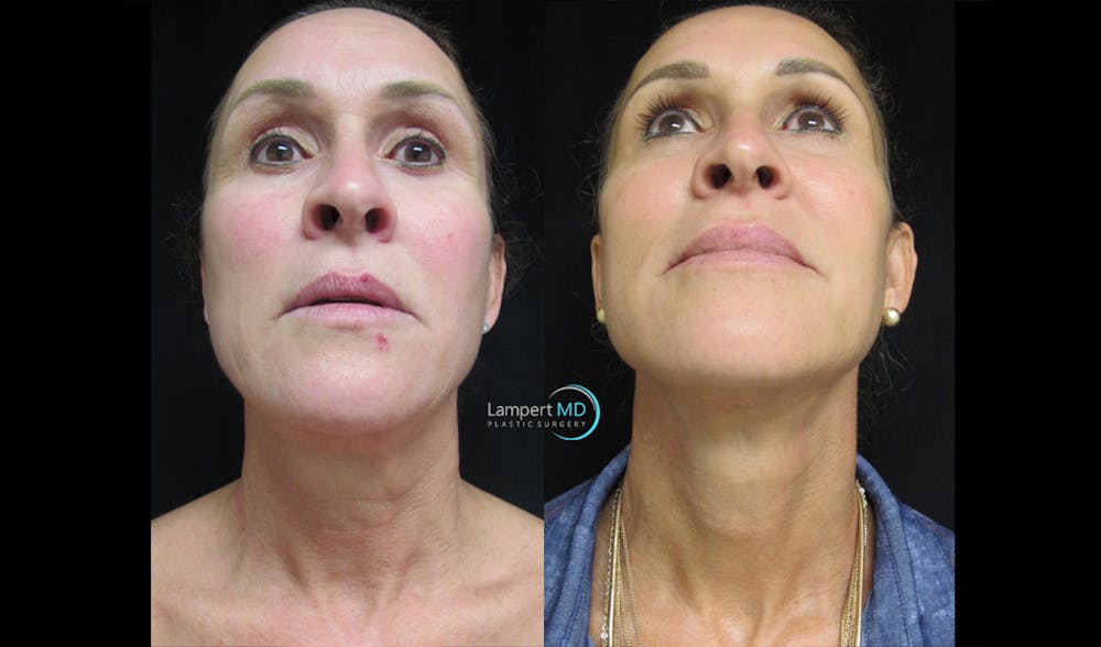 Face & Neck Lift Before & After Gallery - Patient 122908982 - Image 7