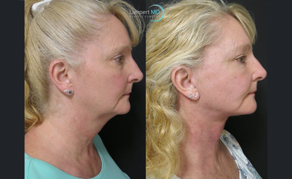 Face & Neck Lift Before & After Gallery - Patient 122908991 - Image 1