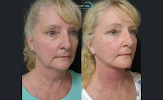 Face & Neck Lift Before & After Gallery - Patient 122908991 - Image 2