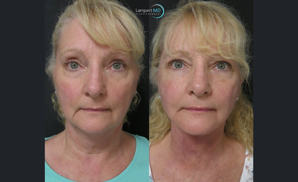 Face & Neck Lift Before & After Gallery - Patient 122908991 - Image 3