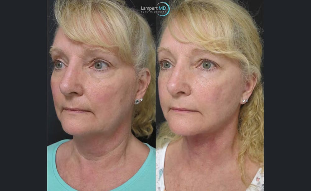 Face & Neck Lift Before & After Gallery - Patient 122908991 - Image 4