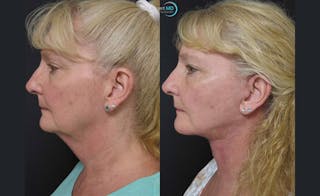 Face & Neck Lift Before & After Gallery - Patient 122908991 - Image 5