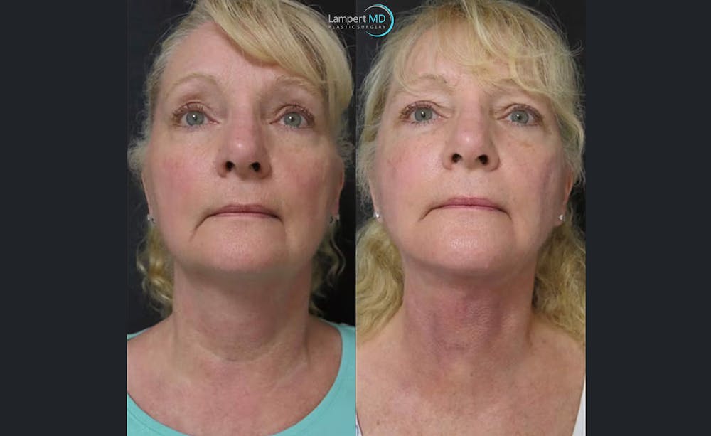 Face & Neck Lift Before & After Gallery - Patient 122908991 - Image 6