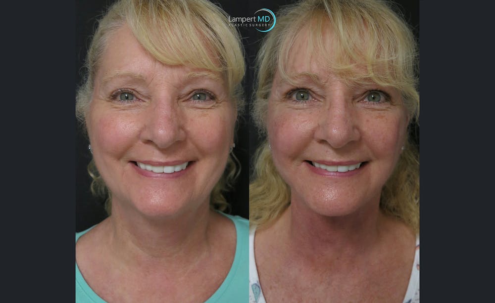 Face & Neck Lift Before & After Gallery - Patient 122908991 - Image 7