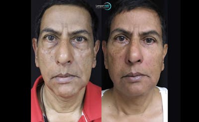 Face & Neck Lift Before & After Gallery - Patient 122908969 - Image 1