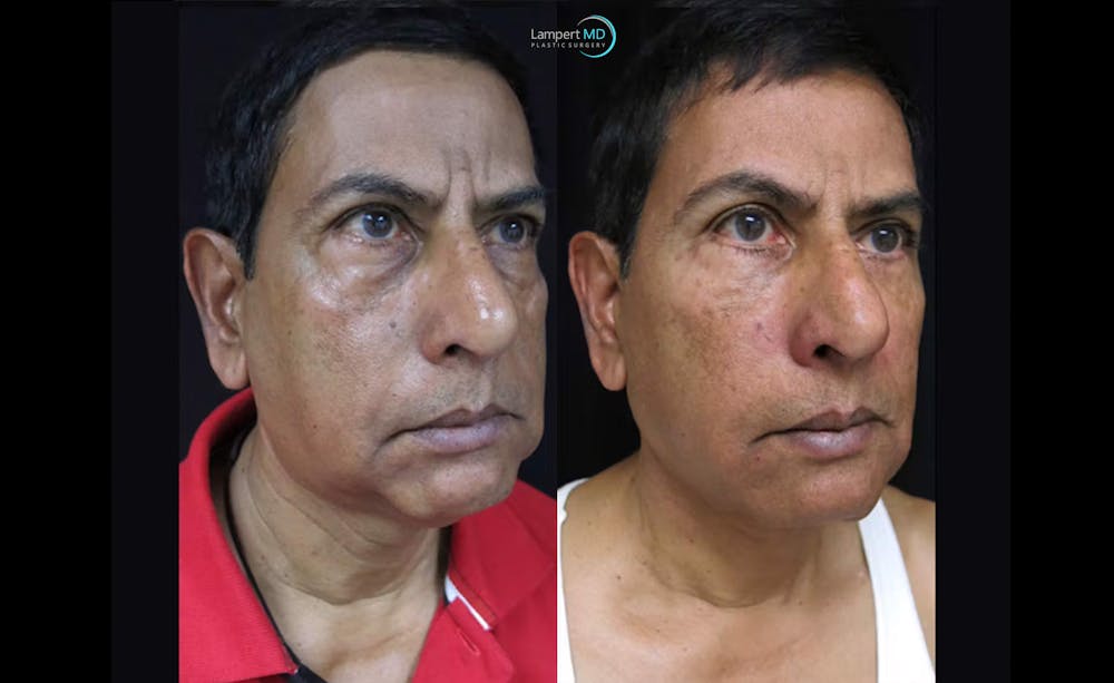 Face & Neck Lift Before & After Gallery - Patient 122908969 - Image 2