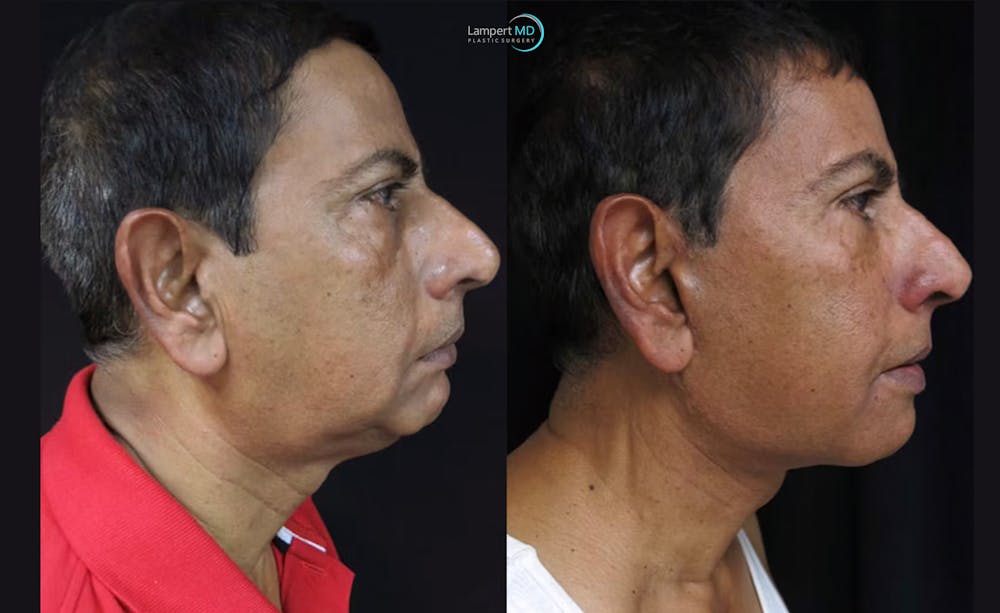Face & Neck Lift Before & After Gallery - Patient 122908969 - Image 3
