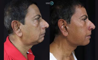Face & Neck Lift Before & After Gallery - Patient 122908969 - Image 3