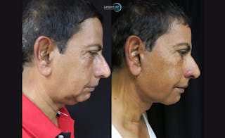 Face & Neck Lift Before & After Gallery - Patient 122908969 - Image 4