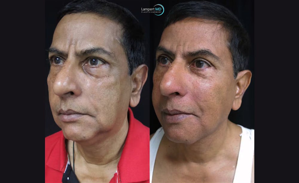 Face & Neck Lift Before & After Gallery - Patient 122908969 - Image 5