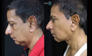 Face & Neck Lift Before & After Gallery - Patient 122908969 - Image 7