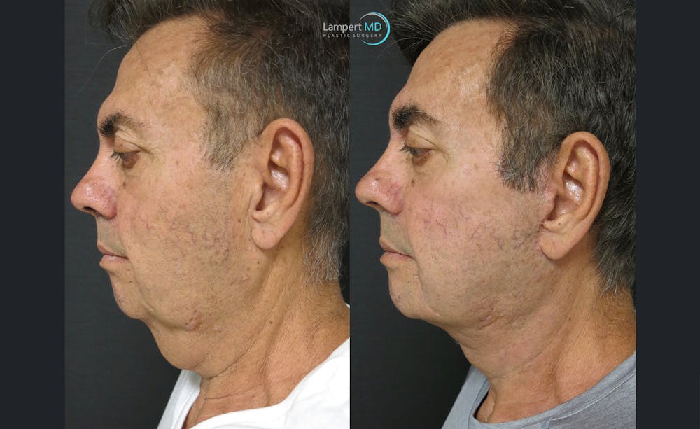 Face & Neck Lift Before & After Gallery - Patient 122908962 - Image 1