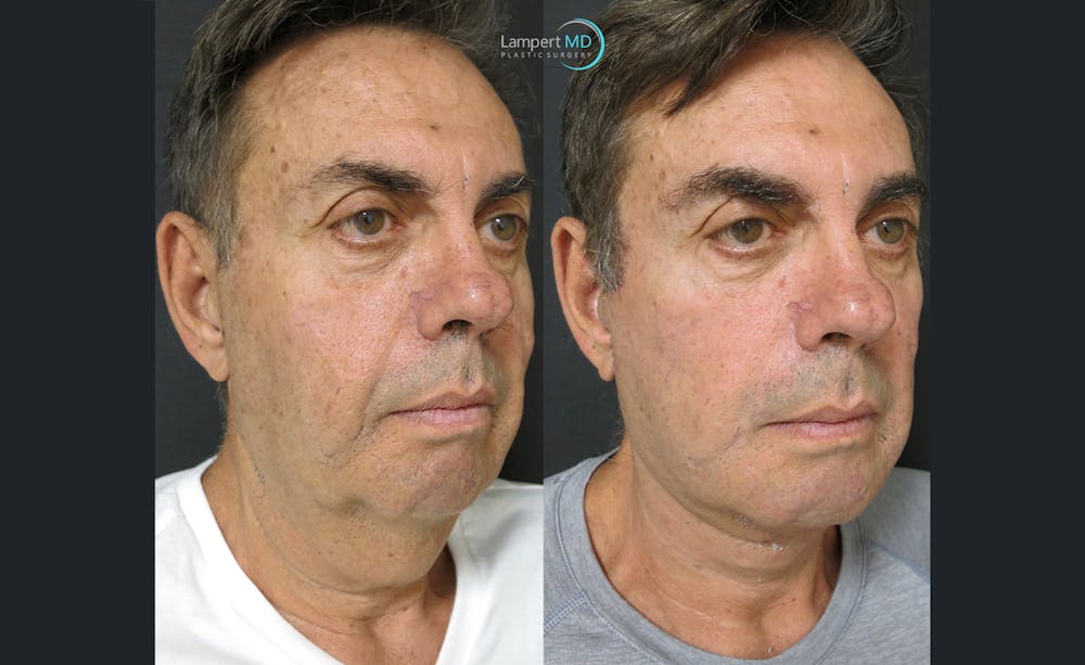 Face & Neck Lift Before & After Gallery - Patient 122908962 - Image 2
