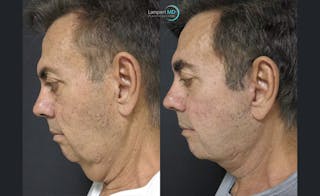 Face & Neck Lift Before & After Gallery - Patient 122908962 - Image 3