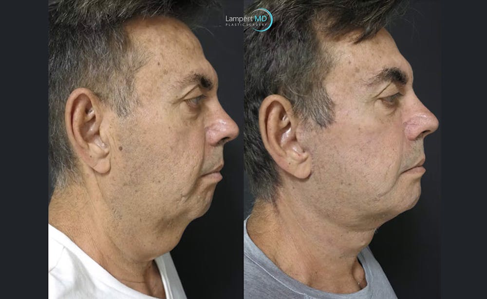 Face & Neck Lift Before & After Gallery - Patient 122908962 - Image 4