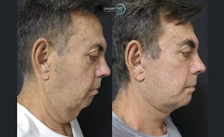 Face & Neck Lift Before & After Gallery - Patient 122908962 - Image 5