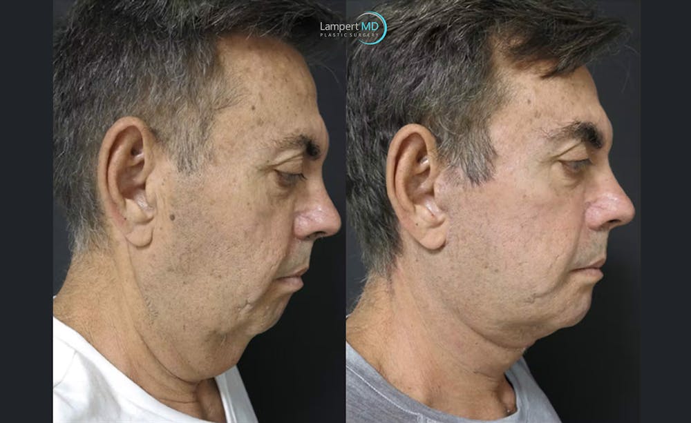 Face & Neck Lift Before & After Gallery - Patient 122908962 - Image 5