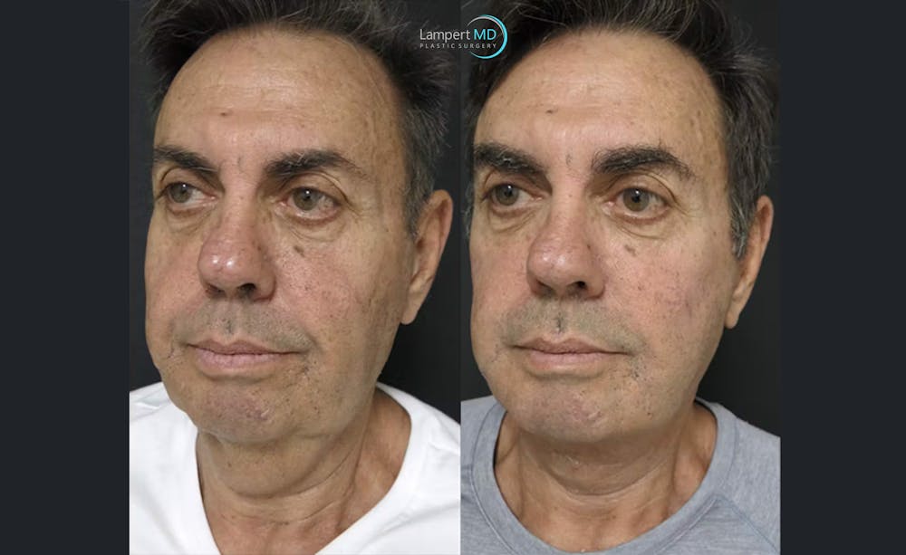 Face & Neck Lift Before & After Gallery - Patient 122908962 - Image 6