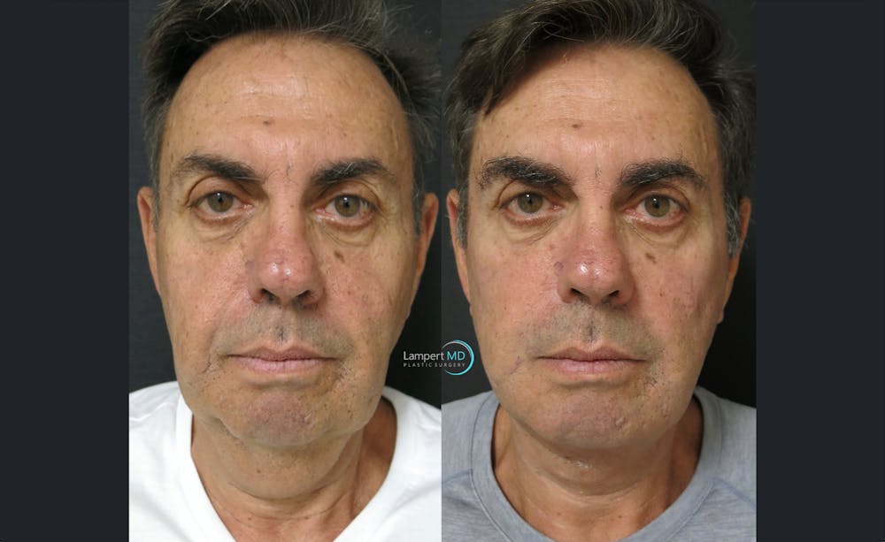 Face & Neck Lift Before & After Gallery - Patient 122908962 - Image 7