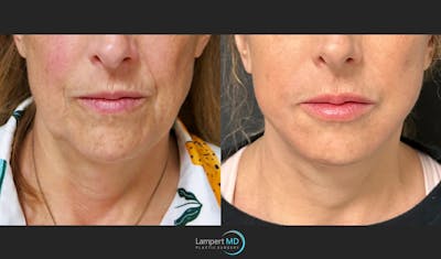 Face & Neck Lift Before & After Gallery - Patient 235124 - Image 1